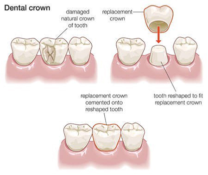 Bridges and crowns