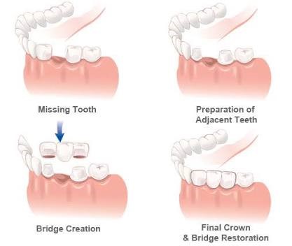Bridges and crowns