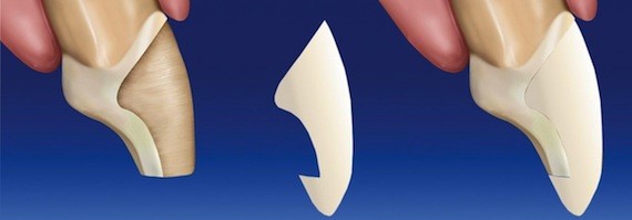 Dental veneers