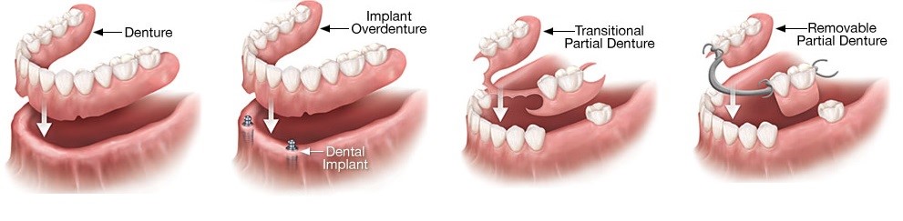 Dentures